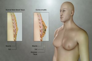 Treating Gynecomastia (Man Boobs)
